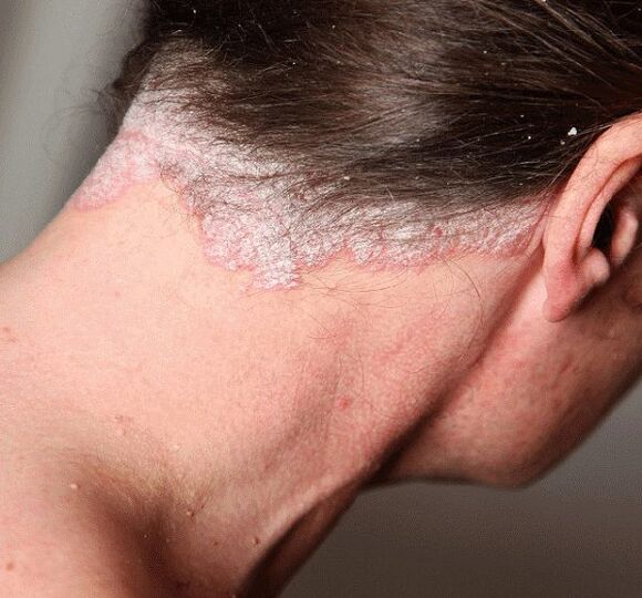 Cum se tratează psoriazisul