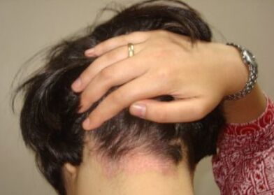 Psoriazis pe cap