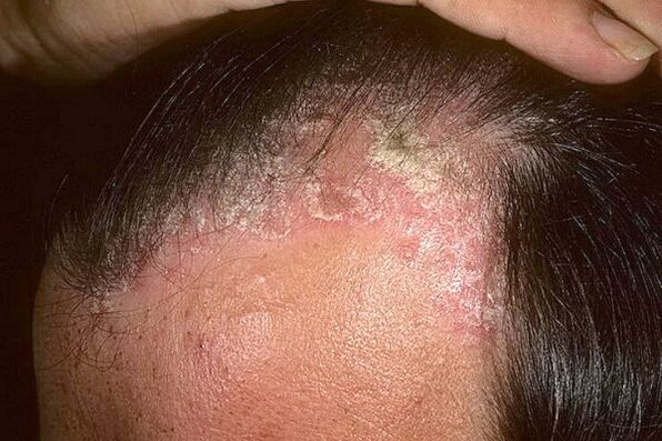 Simptome de psoriazis