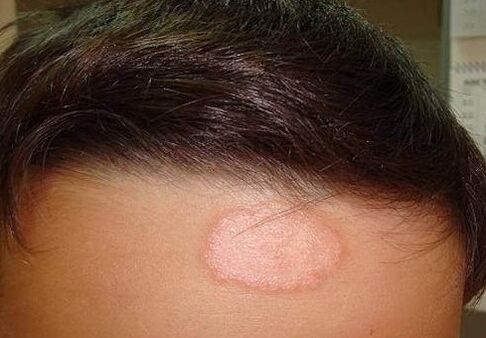 Loc psoriazic